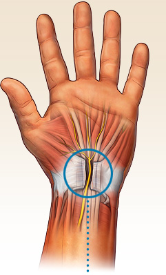 What is Carpal Tunnel Syndrome? — Orthopedics Hawaii